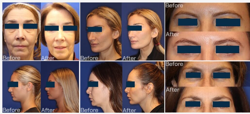 CAMPOS MAGNÉTICOS FOCALIZADOS aumenta el tono muscular facial